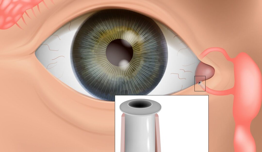 How To Insert and Remove Punctal Plugs Safely
