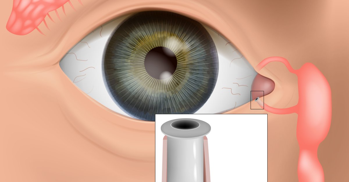 A digital recreation of a human eye with a puncta alongside a demonstration of a punctal plug in a puncta.